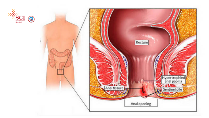 Fissure treatment in Delhi NCR